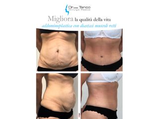 Addominoplastica prima e dopo
