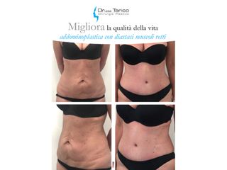 Addominoplastica prima e dopo