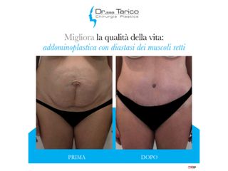 Addominoplastica prima e dopo