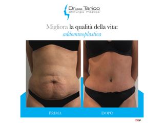 Addominoplastica prima e dopo