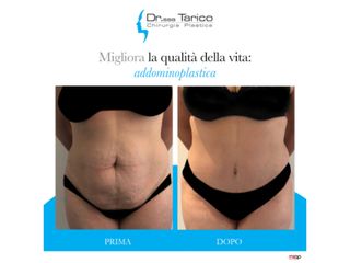 Addominoplastica prima e dopo