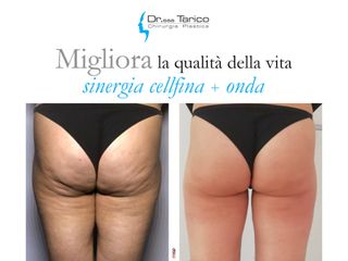 celfina onda prima e dopo