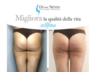 Cellulite prima e dopo