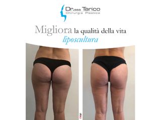 Liposcultura prima e dopo