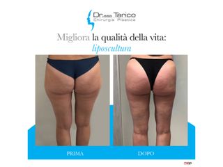 Liposcultura prima e dopo
