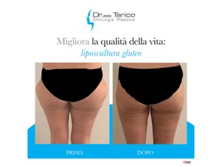 Liposcultura prima e dopo