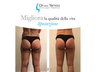 Liposuzione prima e dopo