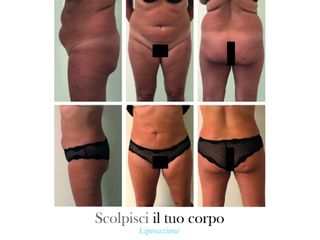 Liposuzione prima e dopo