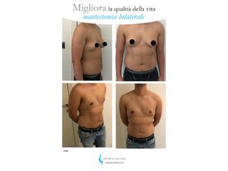 Ginecomastia prima e dopo