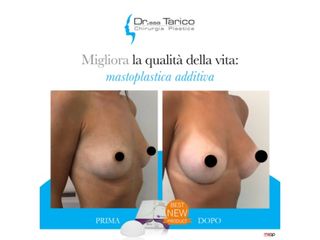 Mastoplastica additiva prima e dopo