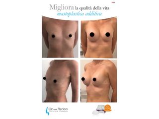 Mastoplastica additiva prima e dopo