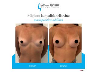 Mastoplastica additiva prima e dopo