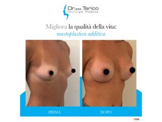 Mastoplastica additiva prima e dopo