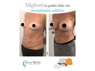 Mastoplastica additiva prima e dopo