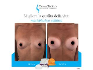 Mastoplastica additiva prima e dopo