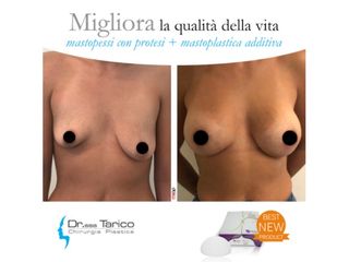 Mastopessi additiva prima e dopo