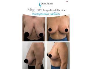 Mastoplastica riduttiva prima e dopo