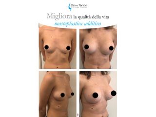 Mastoplastica additiva prima e dopo