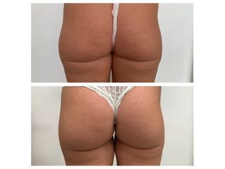 Gluteoplastica prima e dopo