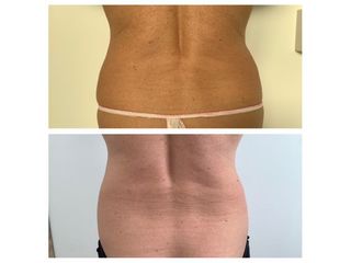 Liposuzione prima e dopo