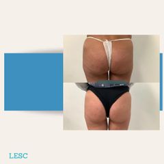 Liposuzione - Dott. Stefano Toschi