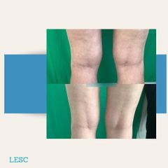 Liposuzione - Dott. Stefano Toschi