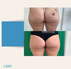 Cellulite - Dott. Stefano Toschi