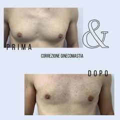 Ginecomastia - Dott. Stefano Toschi