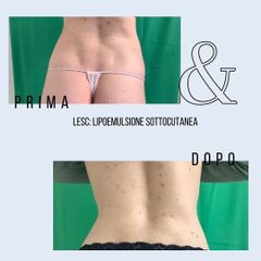 Cellulite - Dott. Stefano Toschi