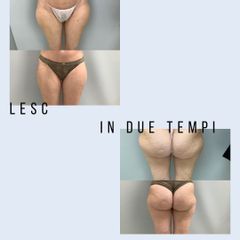 Cellulite - Dott. Stefano Toschi