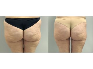 Liposuzione - Dott. Stefano Toschi