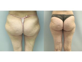 Liposuzione - Dott. Stefano Toschi