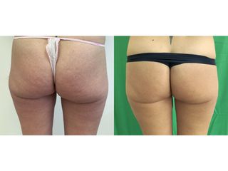Liposuzione - Dott. Stefano Toschi