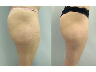 Liposuzione - Dott. Stefano Toschi