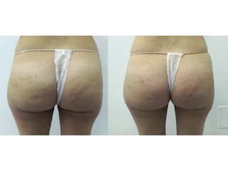 Liposuzione - Dott. Stefano Toschi
