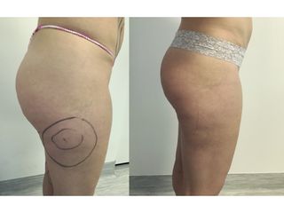 Liposuzione - Dott. Stefano Toschi