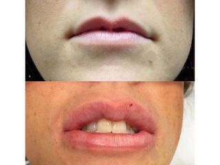 Filler labbra - Dr. Gioia Mario