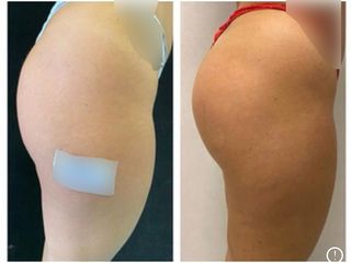 Gluteoplastica - Dr. Gioia Mario