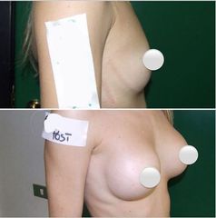 Mastoplastica additiva - Dr. Gioia Mario