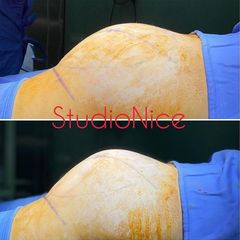 Gluteoplastica - Dr. Gioia Mario