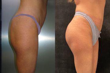Gluteoplastica - Dr. Gioia Mario