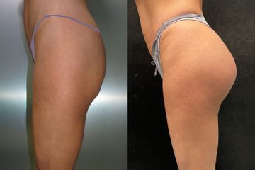 Gluteoplastica - Dr. Gioia Mario