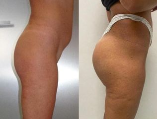 Gluteoplastica - Dr. Gioia Mario