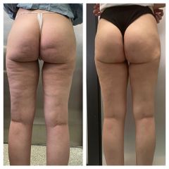 Cellfina per cellulite - Dr. Gioia Mario