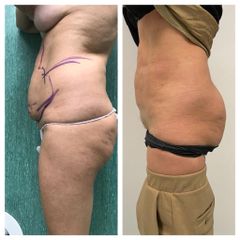 Liposuzione - Dr. Gioia Mario