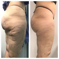 Trattamento Cellfina per cellulite - Dr. Gioia Mario