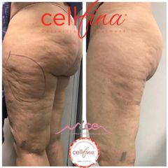 Cellulite - Dr. Gioia Mario