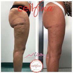 Cellulite - Dr. Gioia Mario