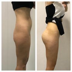 Dr. Gioia Mario Gluteoplastica