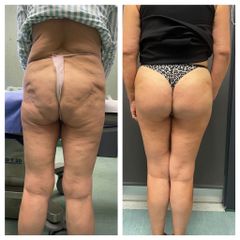 Dr. Gioia Mario Gluteoplastica